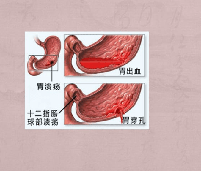 十二指肠球部溃疡a2期是什么意思