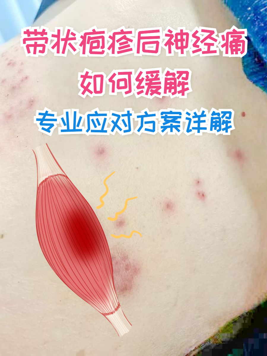 什么是带状疱疹后遗神经痛?