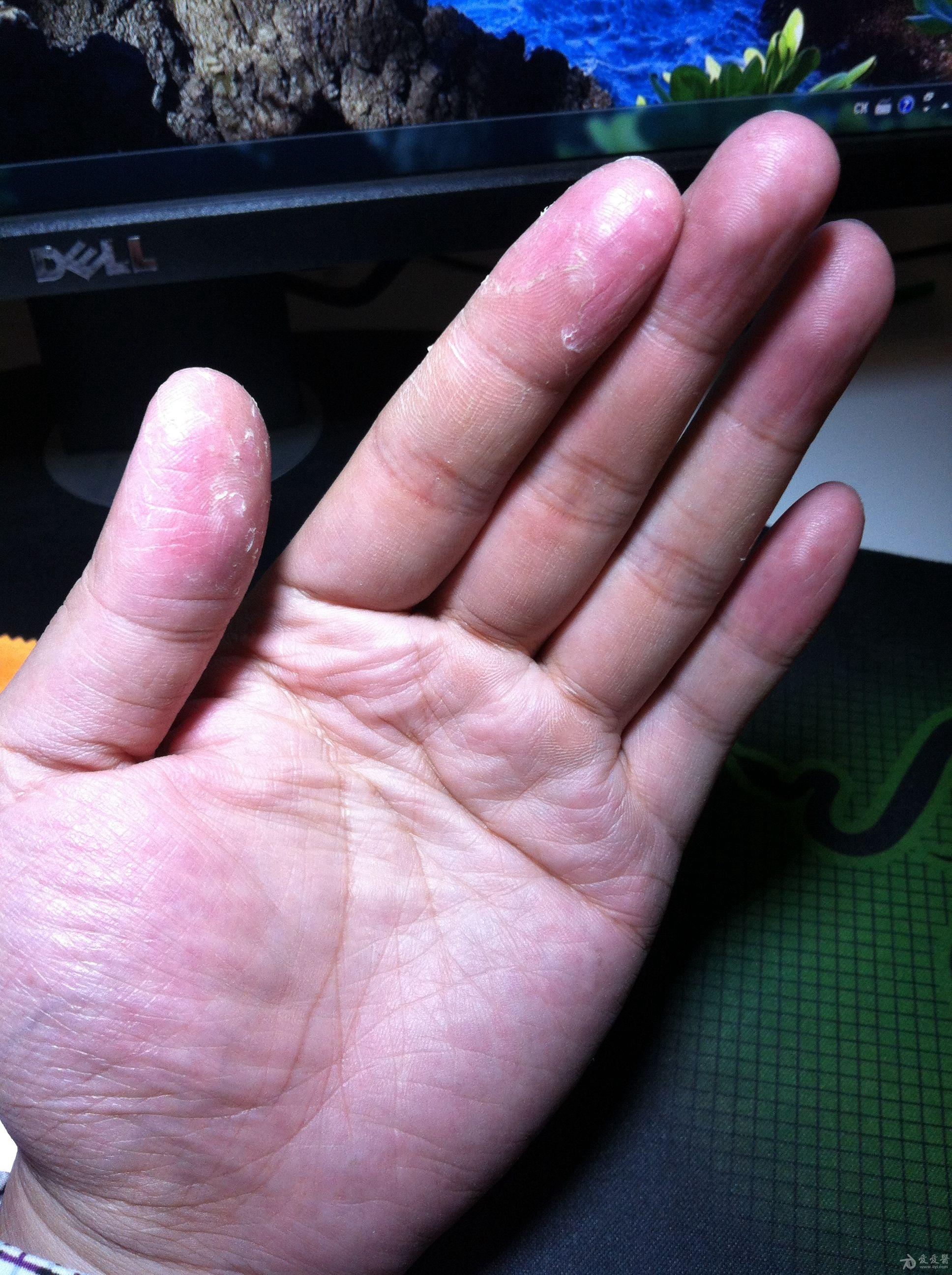 手部脱皮但是不痛不痒