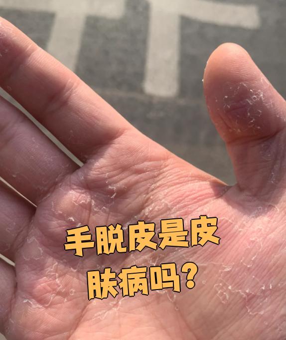 手部脱皮但是不痛不痒