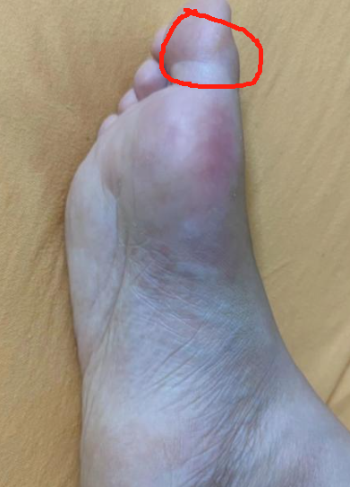 大母脚趾疼是痛风吗?