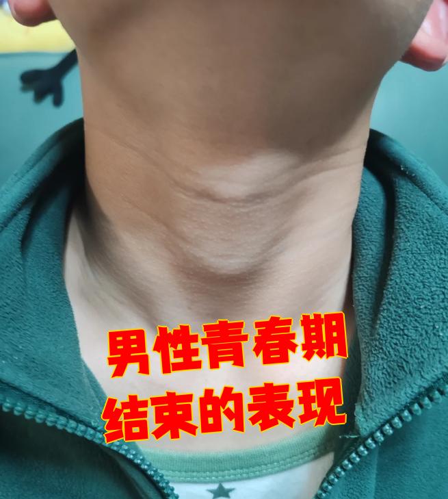 雄性激素过多的症状是什么