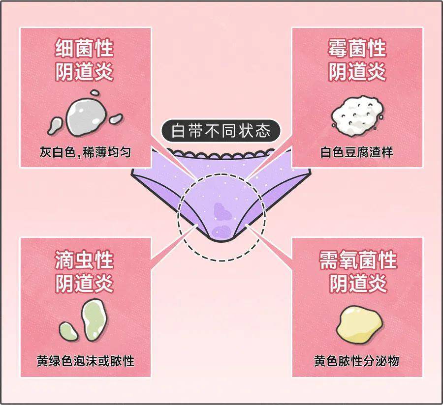 霉菌性阴道炎有哪些症状