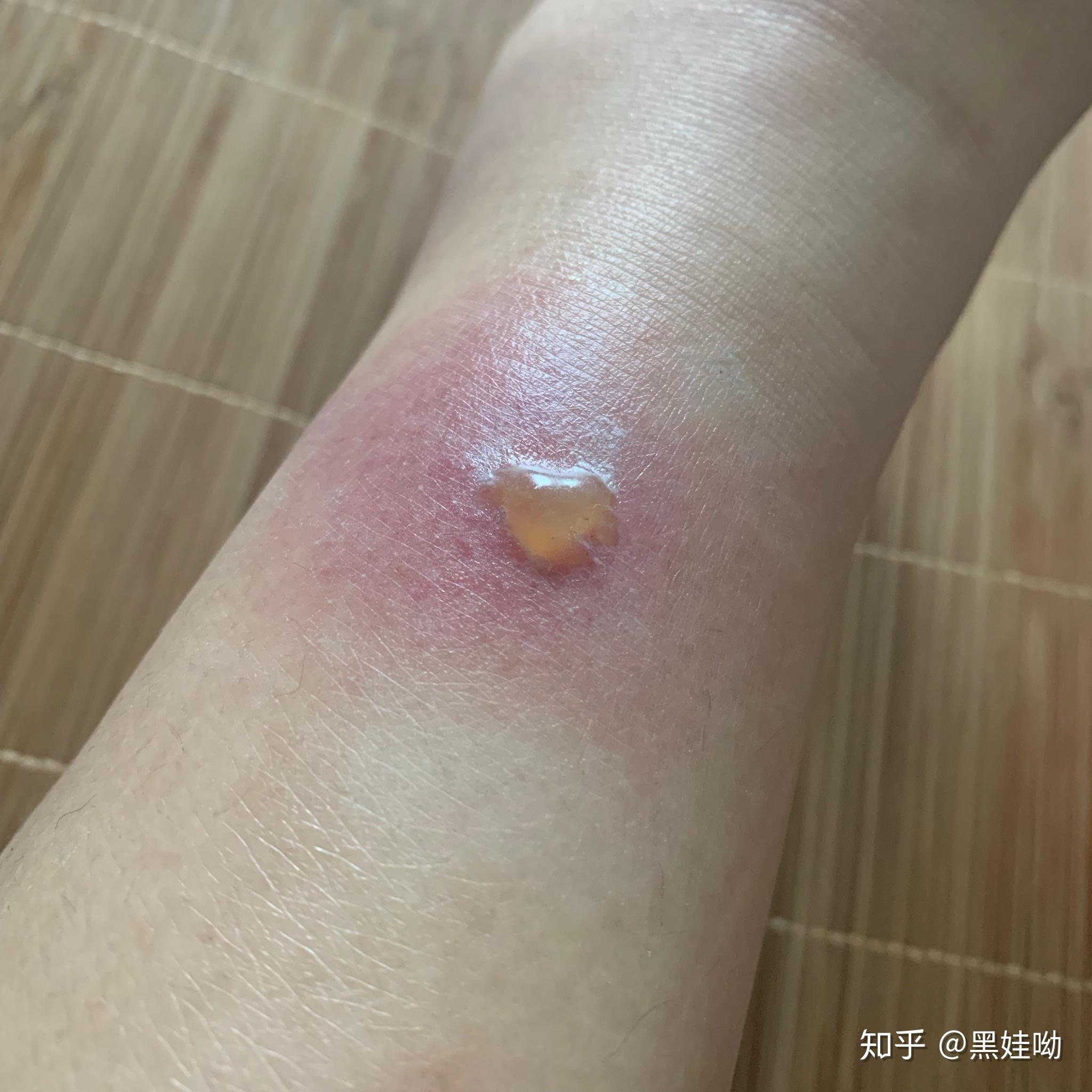 被蚊子叮咬后起硬疙瘩.