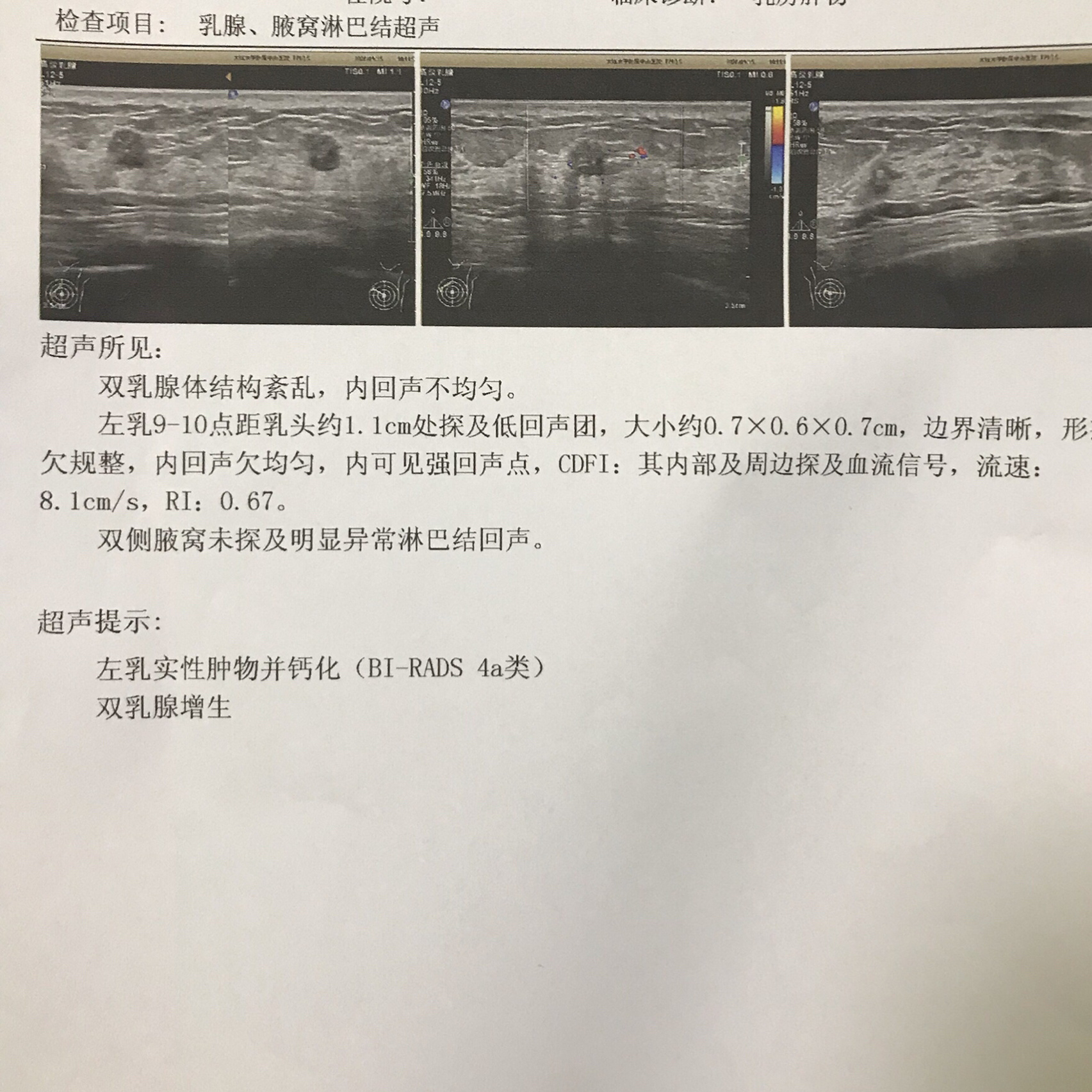 乳腺钼靶、彩超哪个更准确