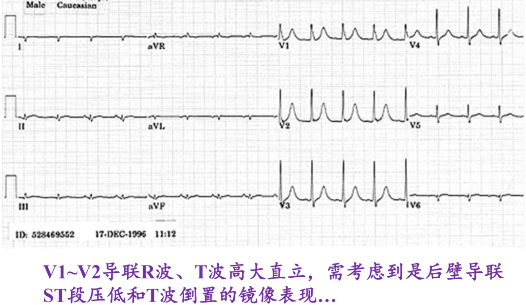 T波高尖严重吗?