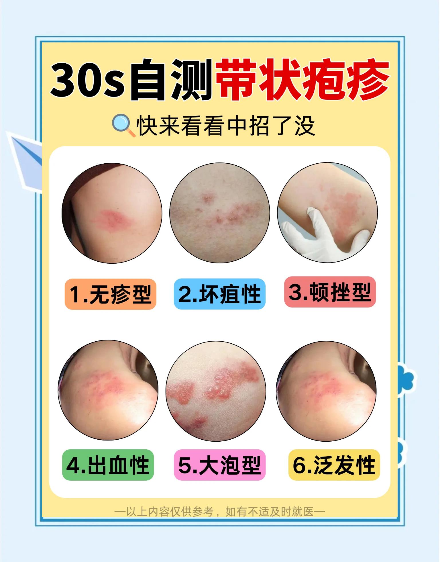 带状疱疹的一些治疗方式