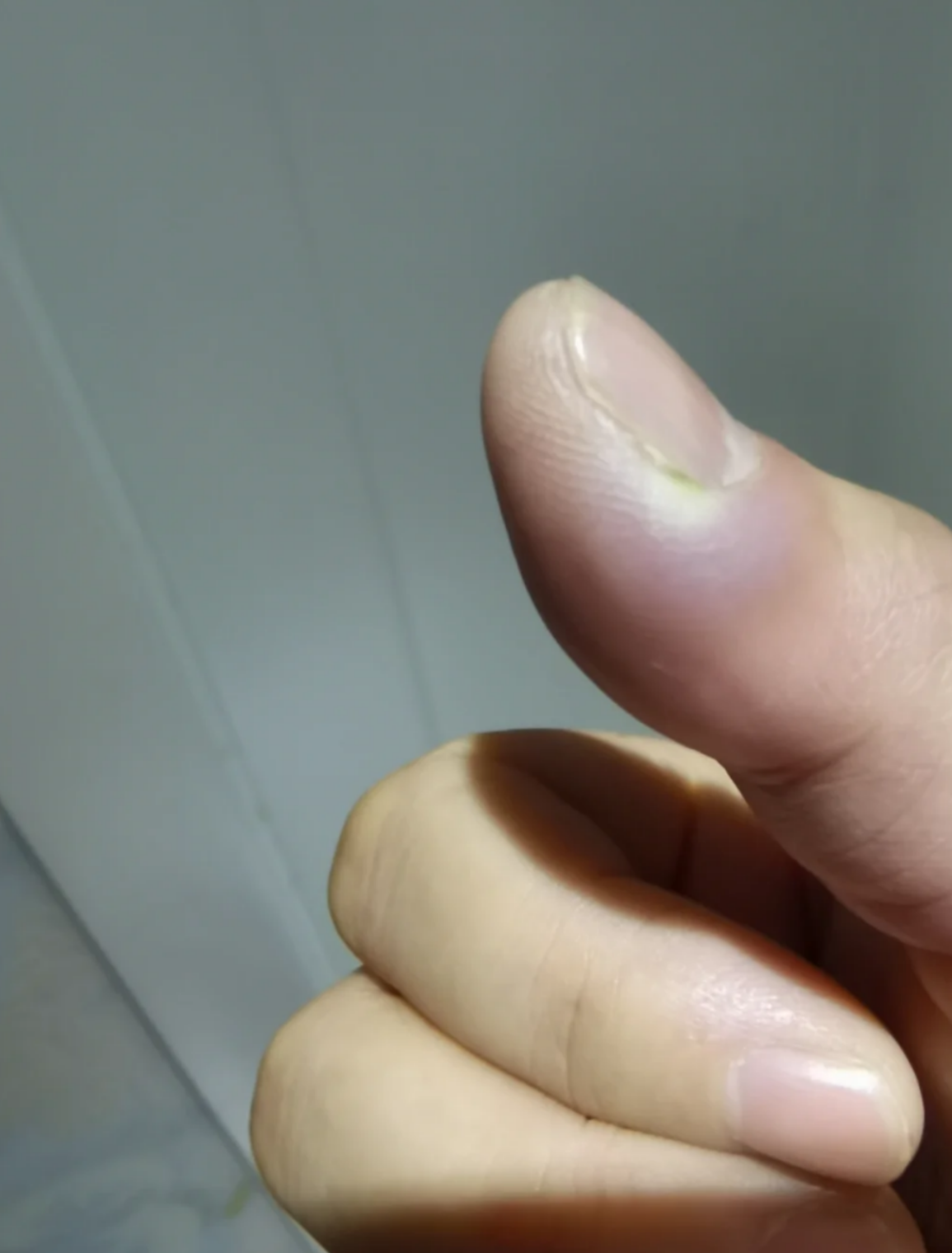 大拇指有点痛怎么回事