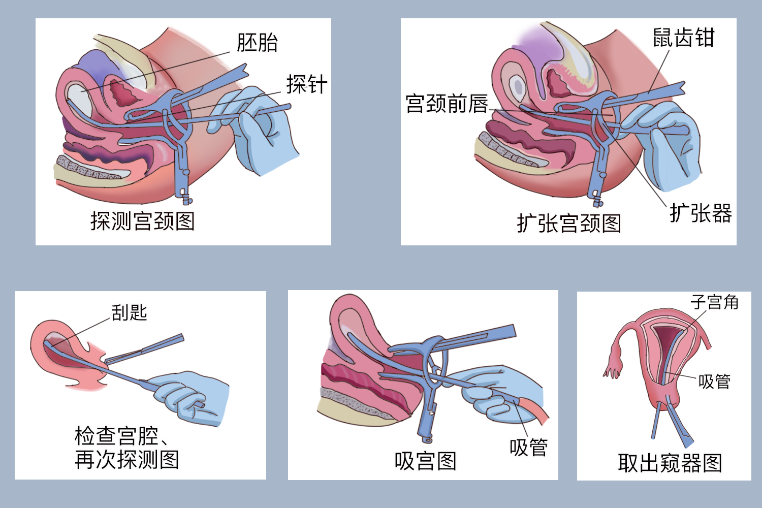 无痛人流手术要多久