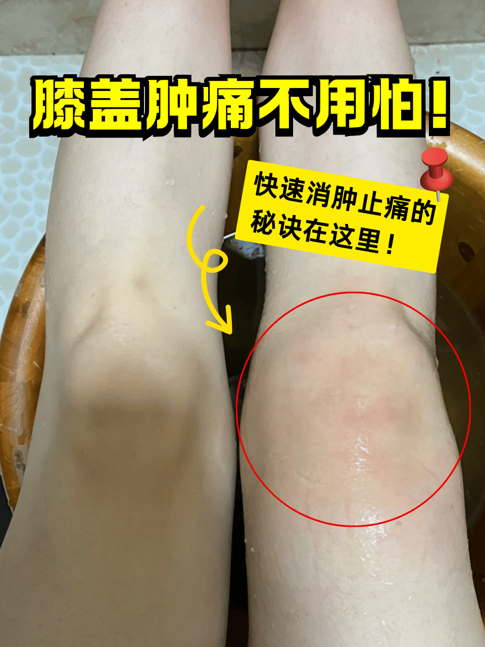 被蝎子蛰了快速止痛方法