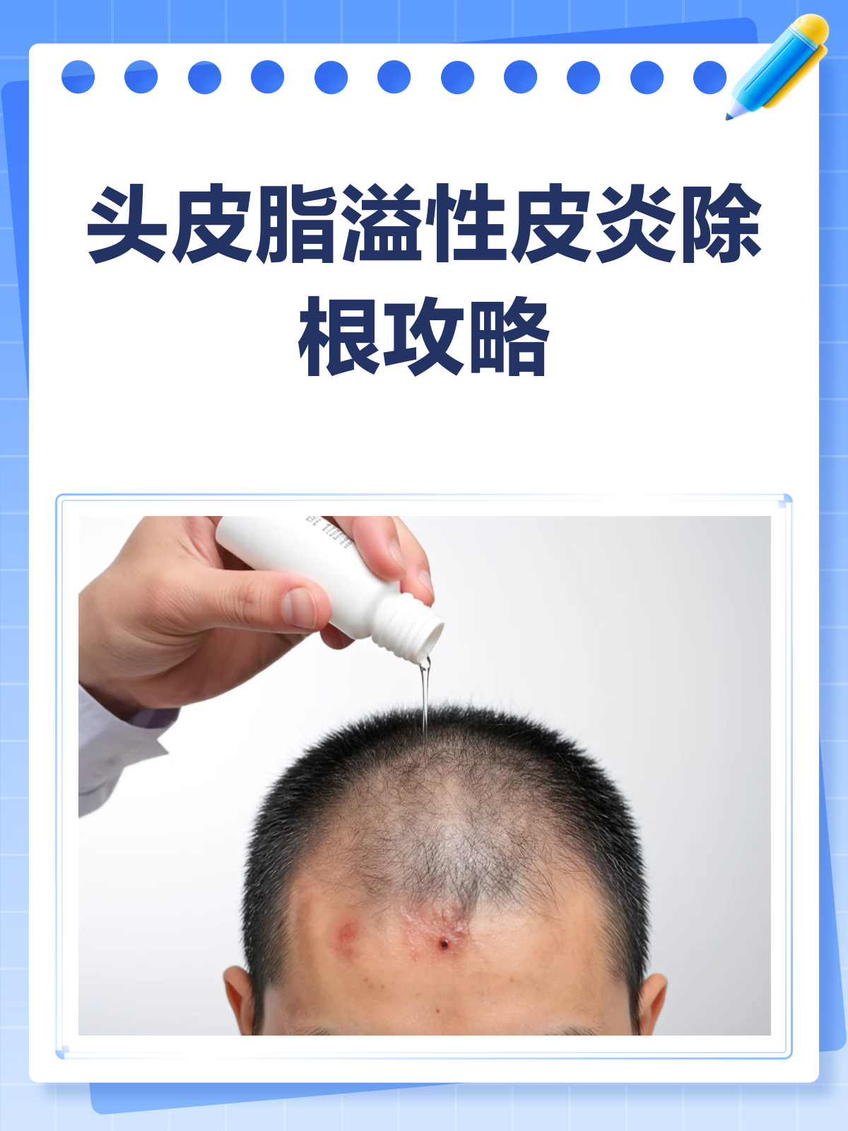 头部脂溢性皮炎可以根治吗