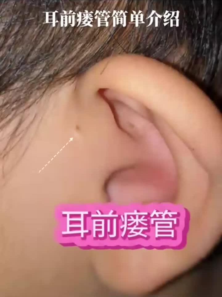 先天性耳前瘘管是什么病