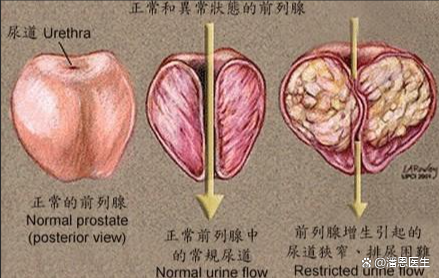 非细菌性前列腺炎什么症状?