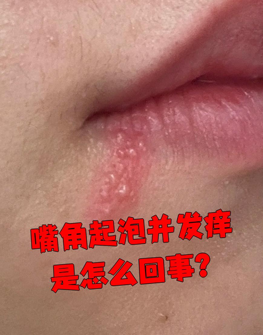 嘴角起泡发痒怎么办