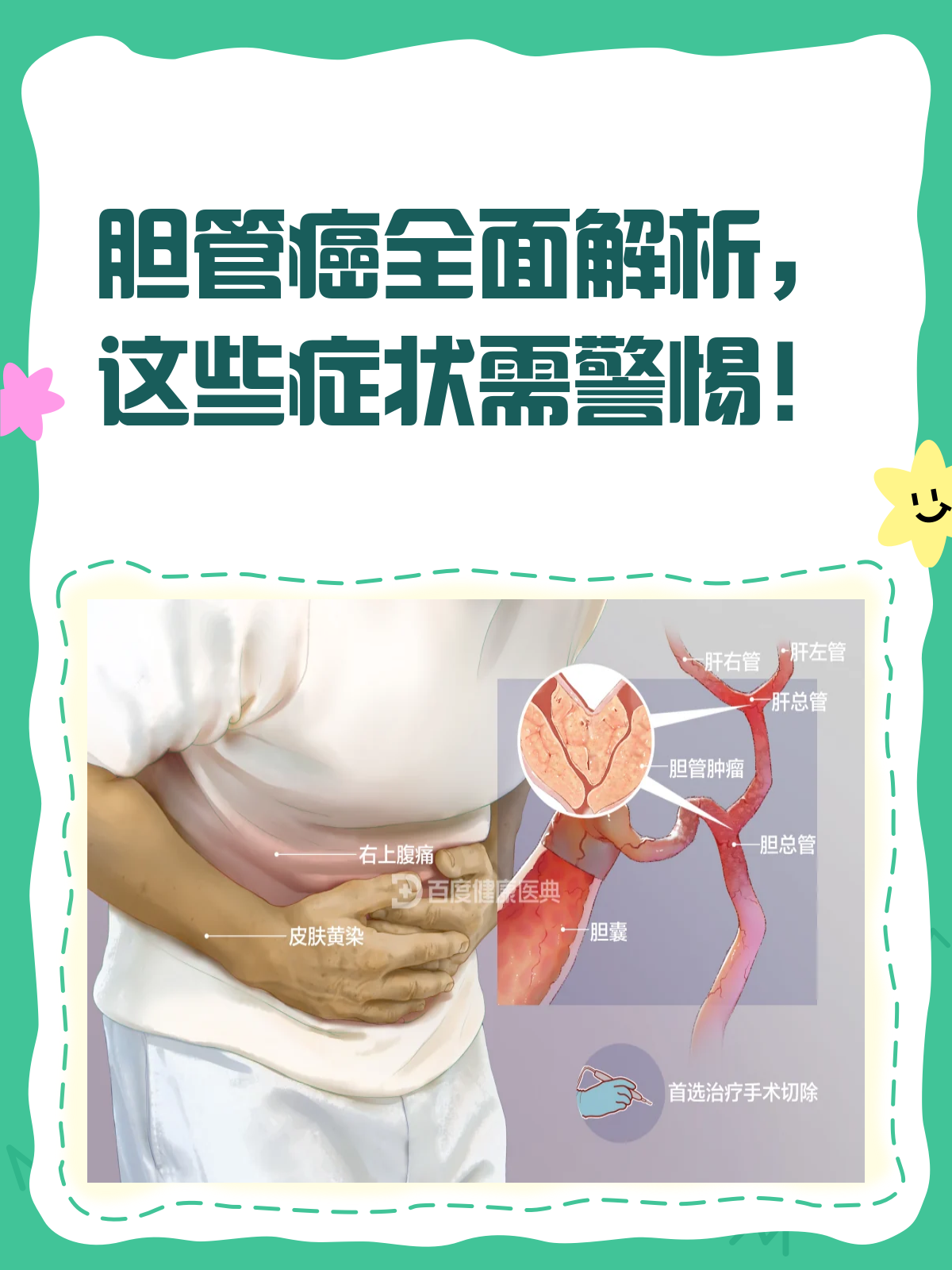 胆管癌能治好吗