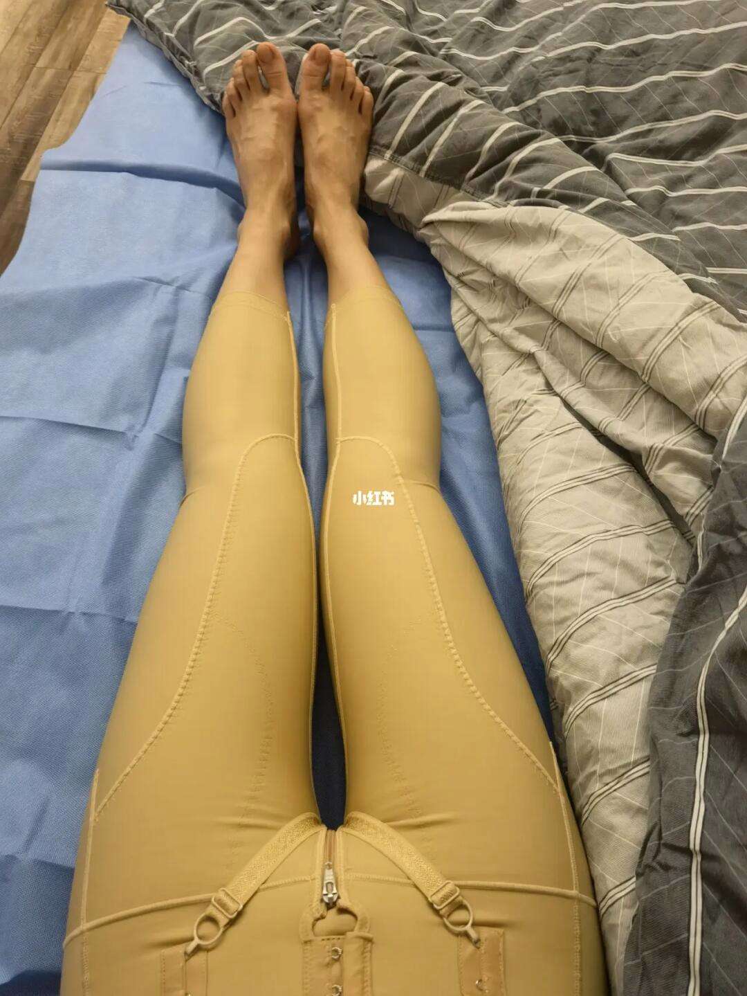 大腿抽脂的后遗症是什么?