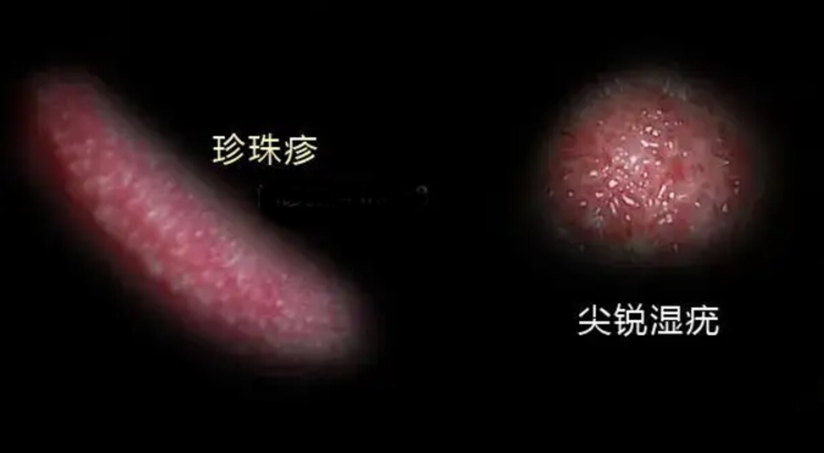 龟头上起疙瘩