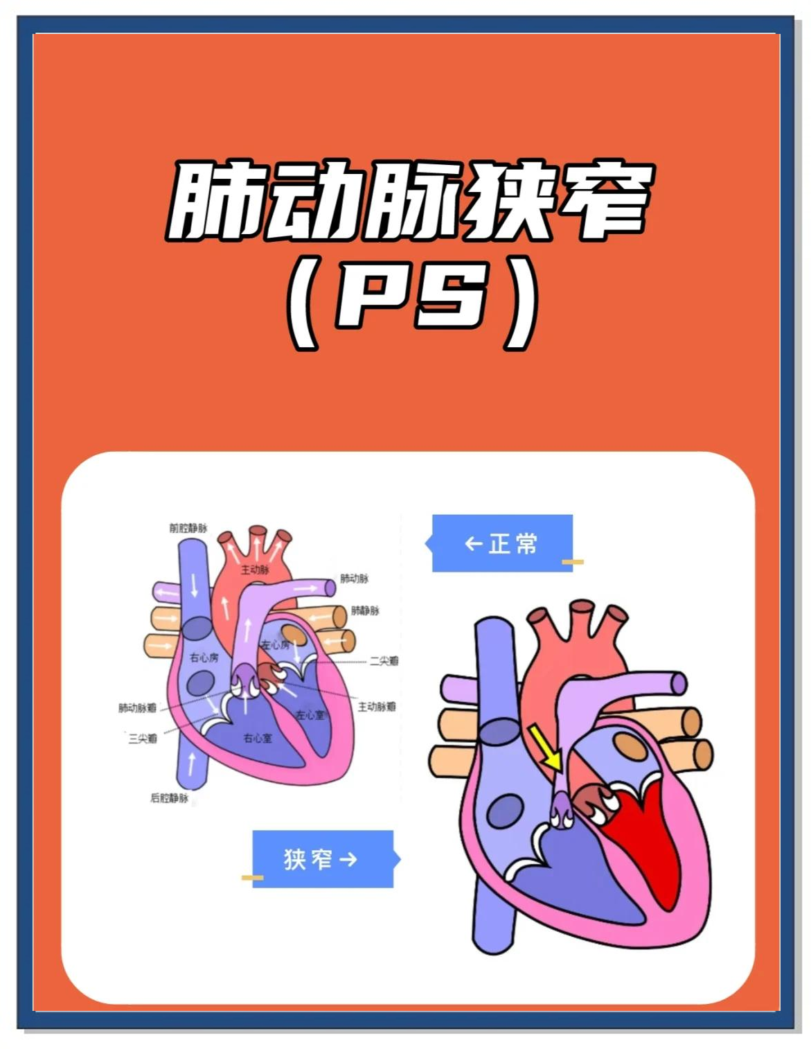 肺动脉高压的原因