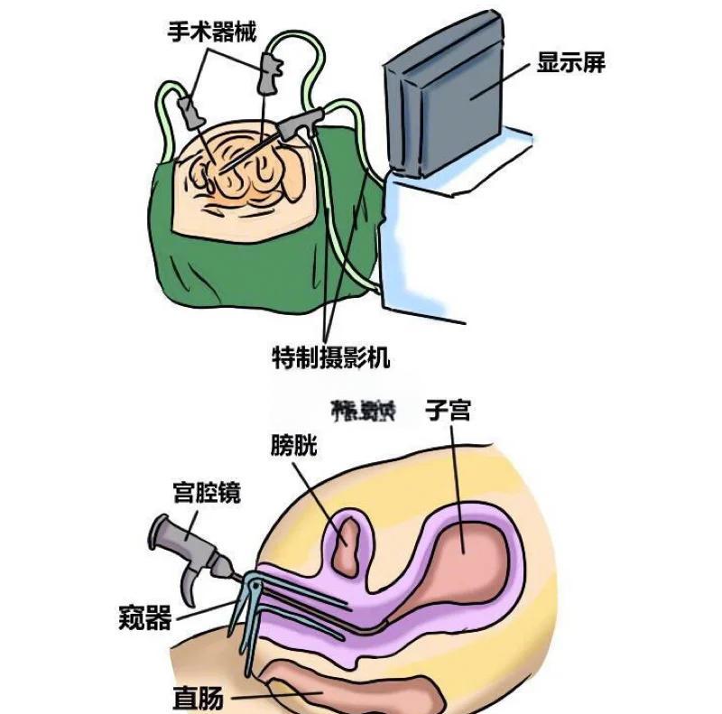 一般宫腔镜检查的步骤
