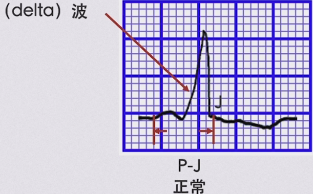 预激综合症B型严重么?
