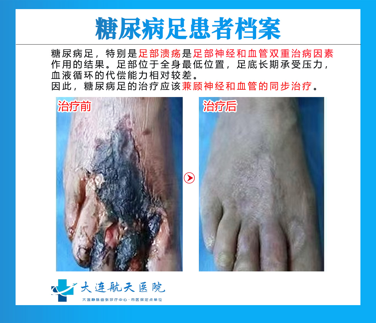糖尿病的症状表现