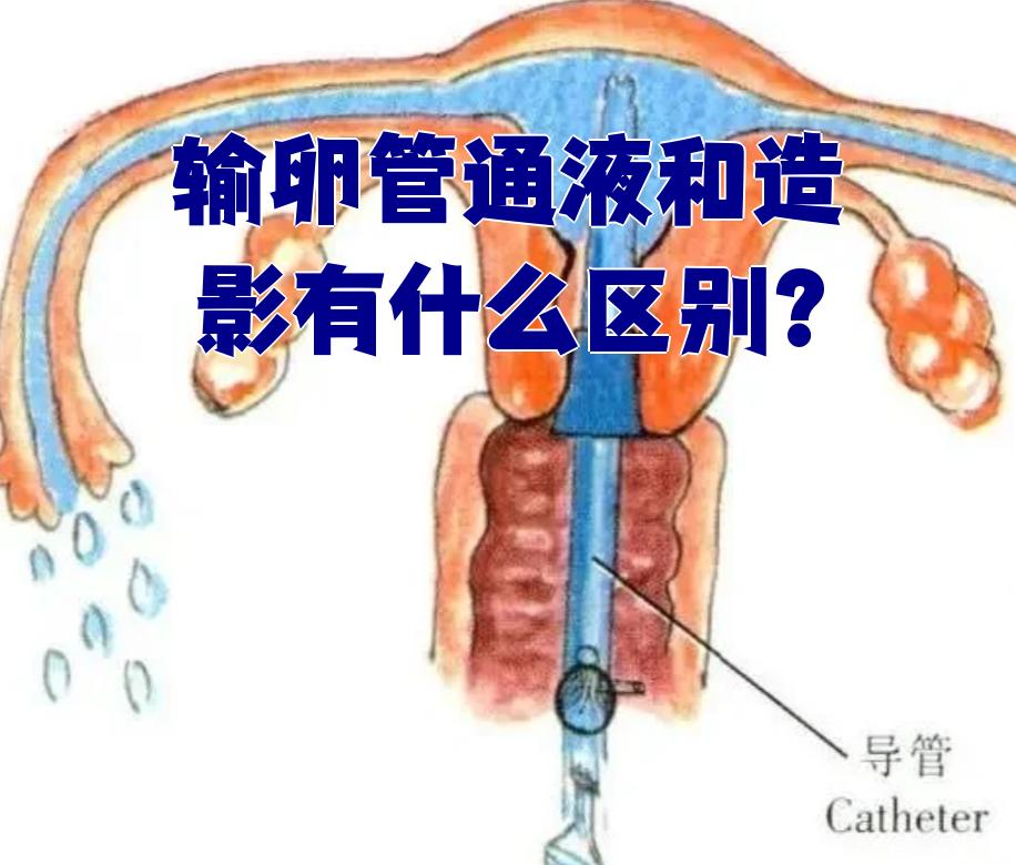输卵管造影具体是什么