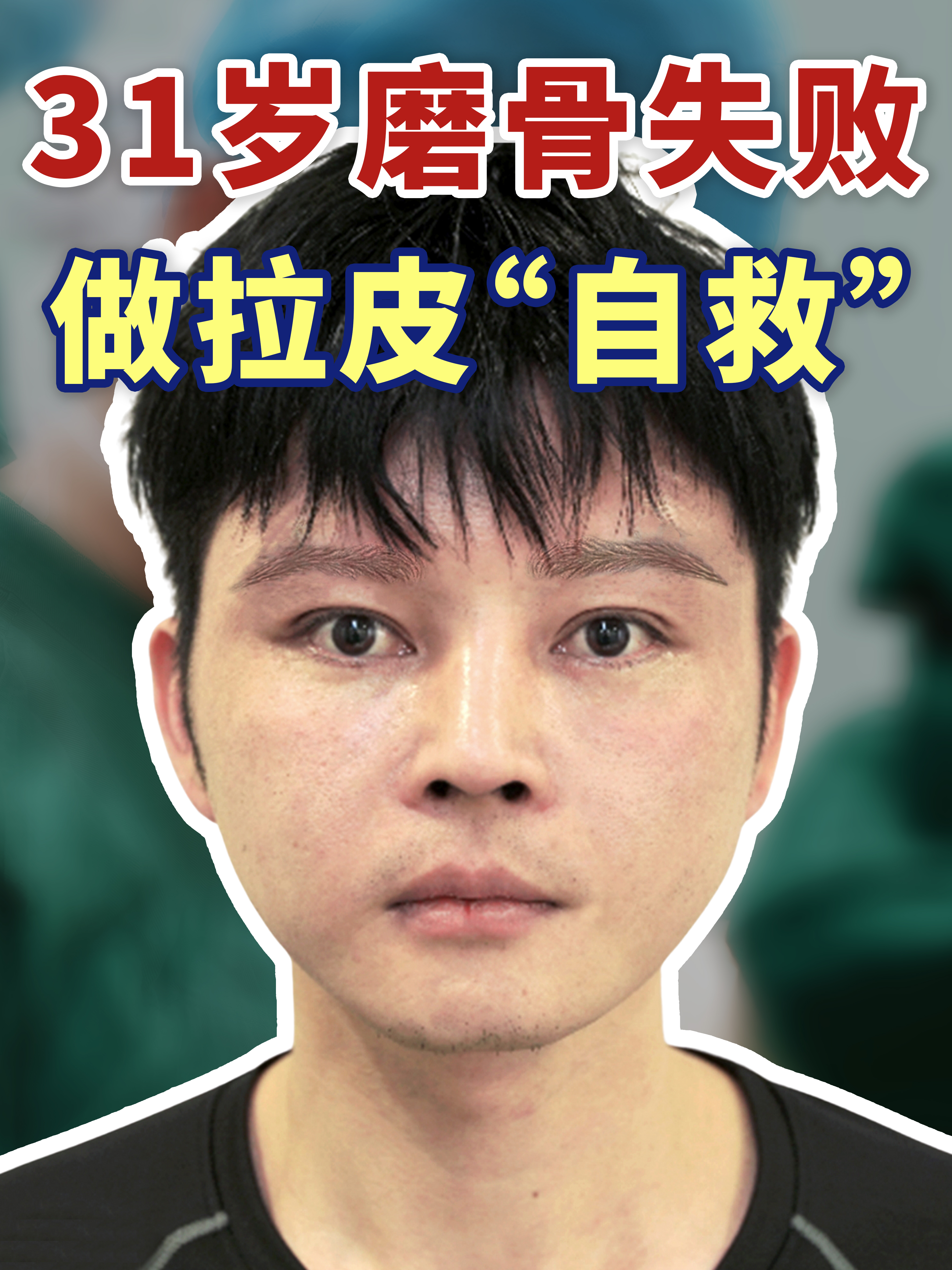 怎样使颧骨变小,不动手术.