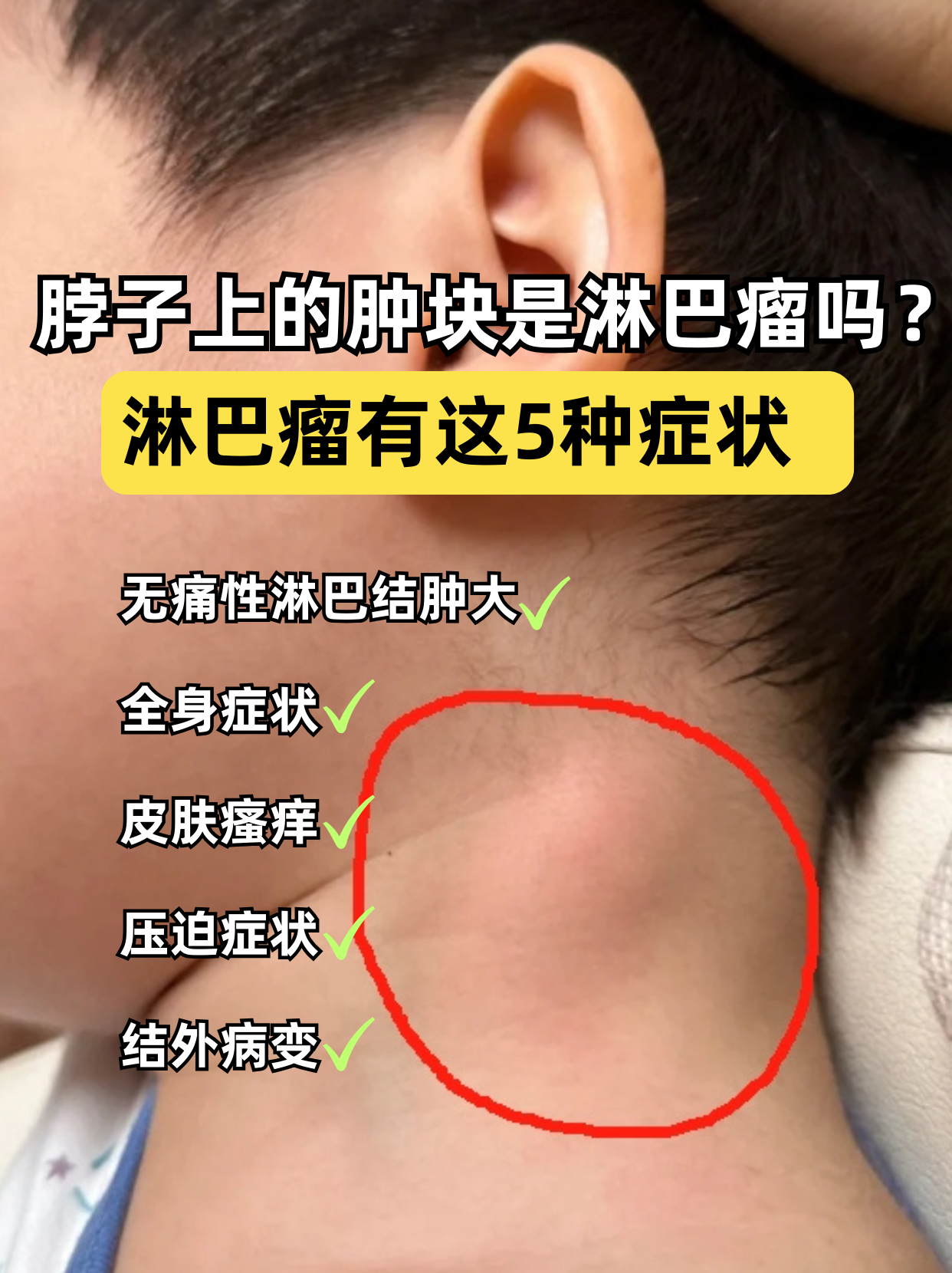 脖子右侧有肿块,一摸很疼