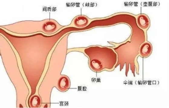 宫外孕征兆