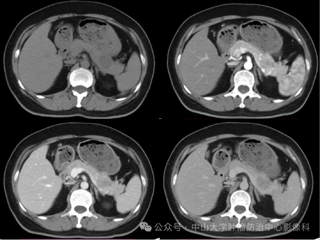 胰腺囊腺瘤是什么病