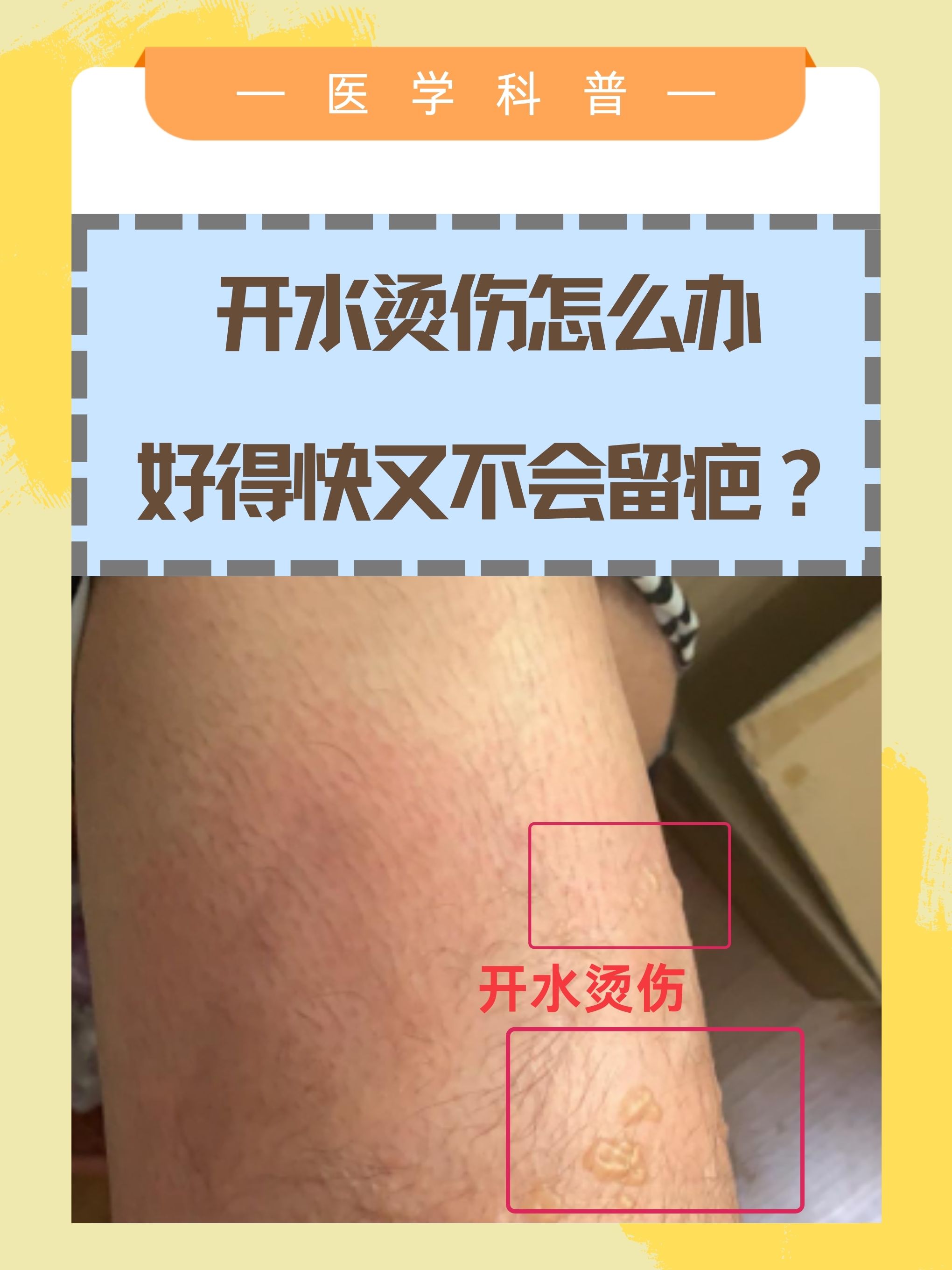 皮肤被开水烫伤该怎么处理