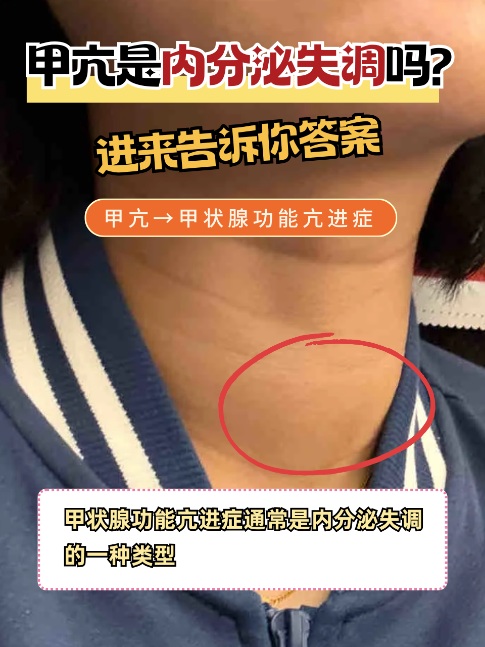 甲状腺功能减退的症状是什么?