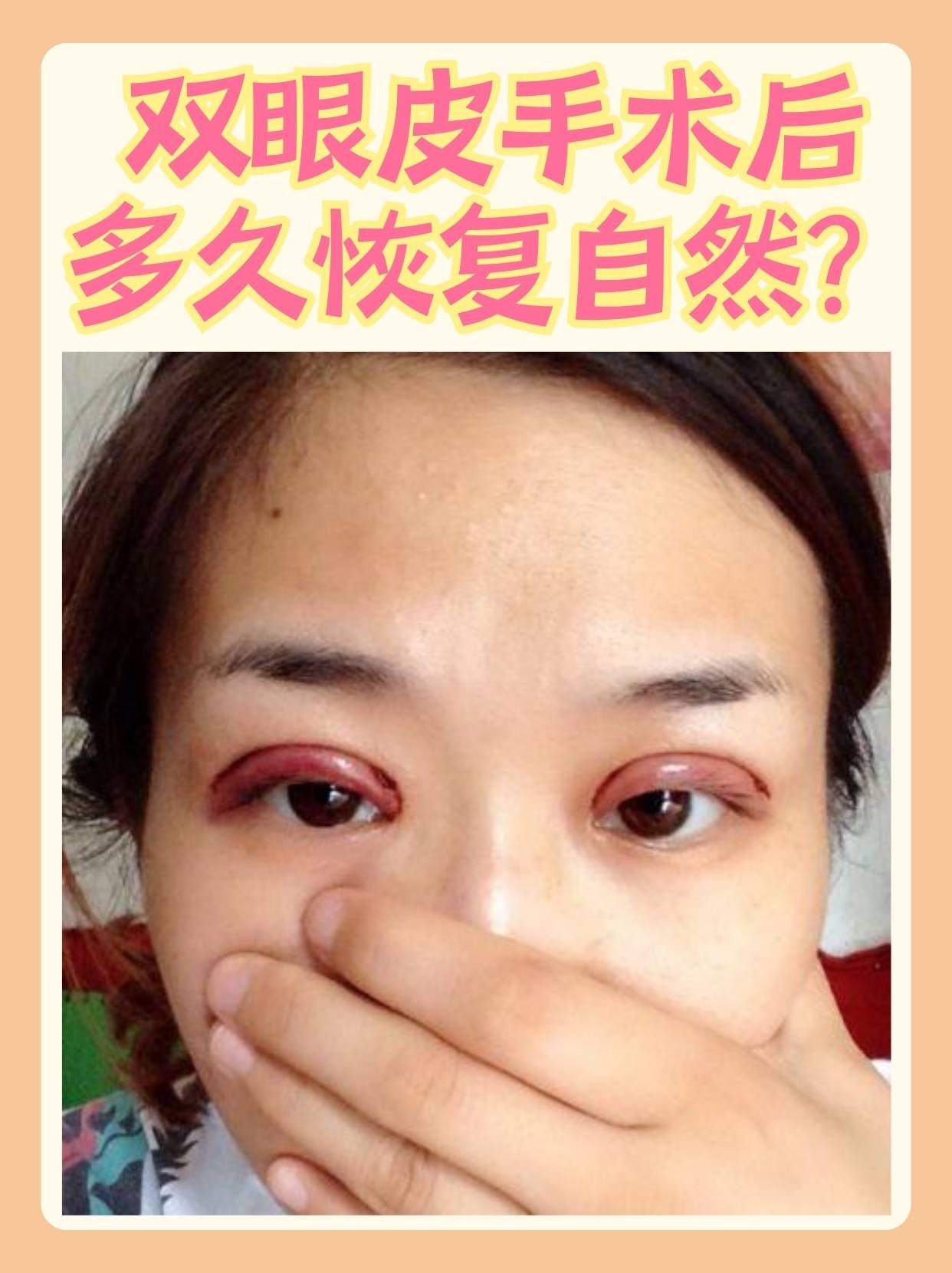 割双眼皮要多久之后可以恢复?