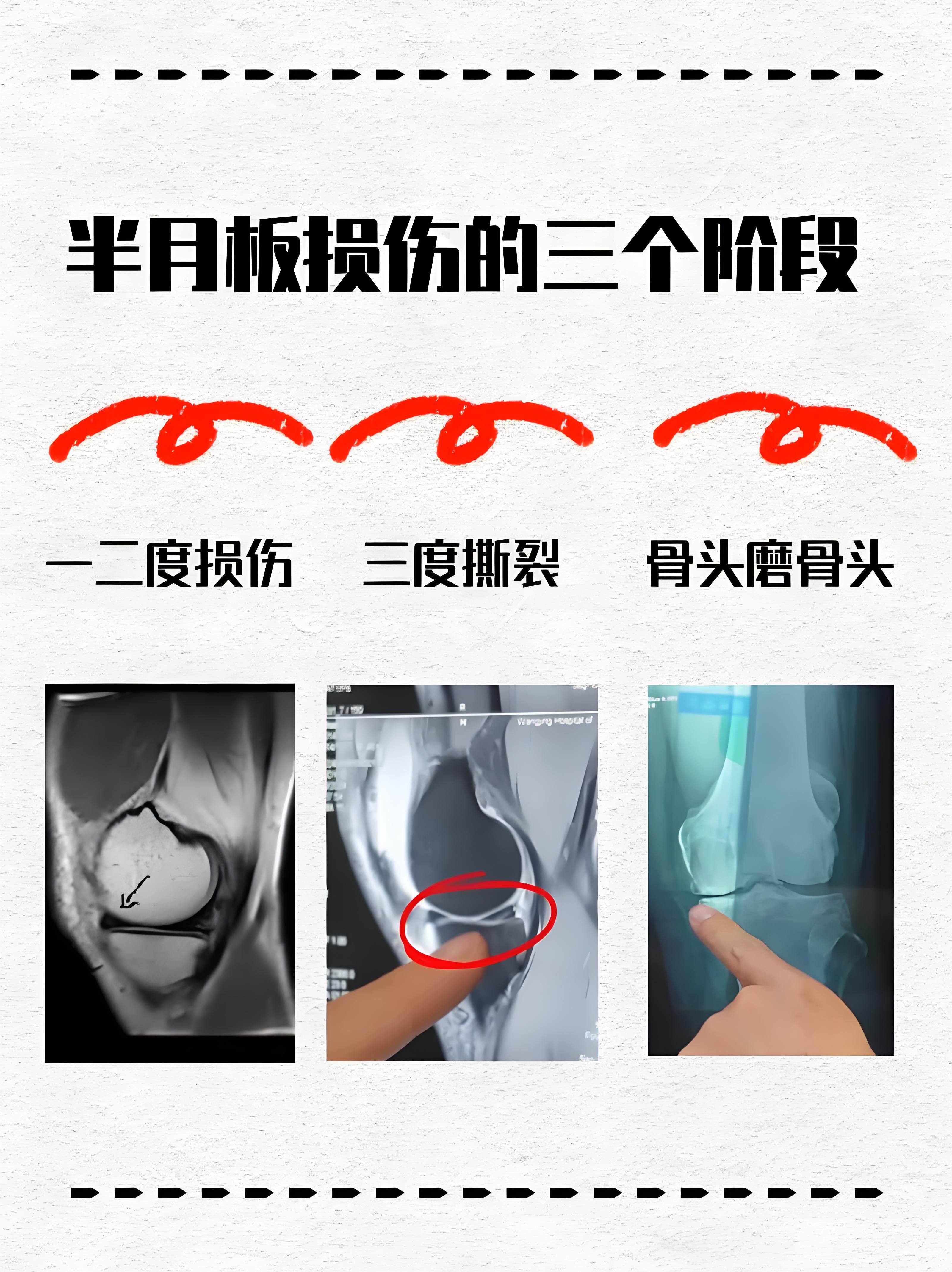 膝盖酸疼是怎么回事