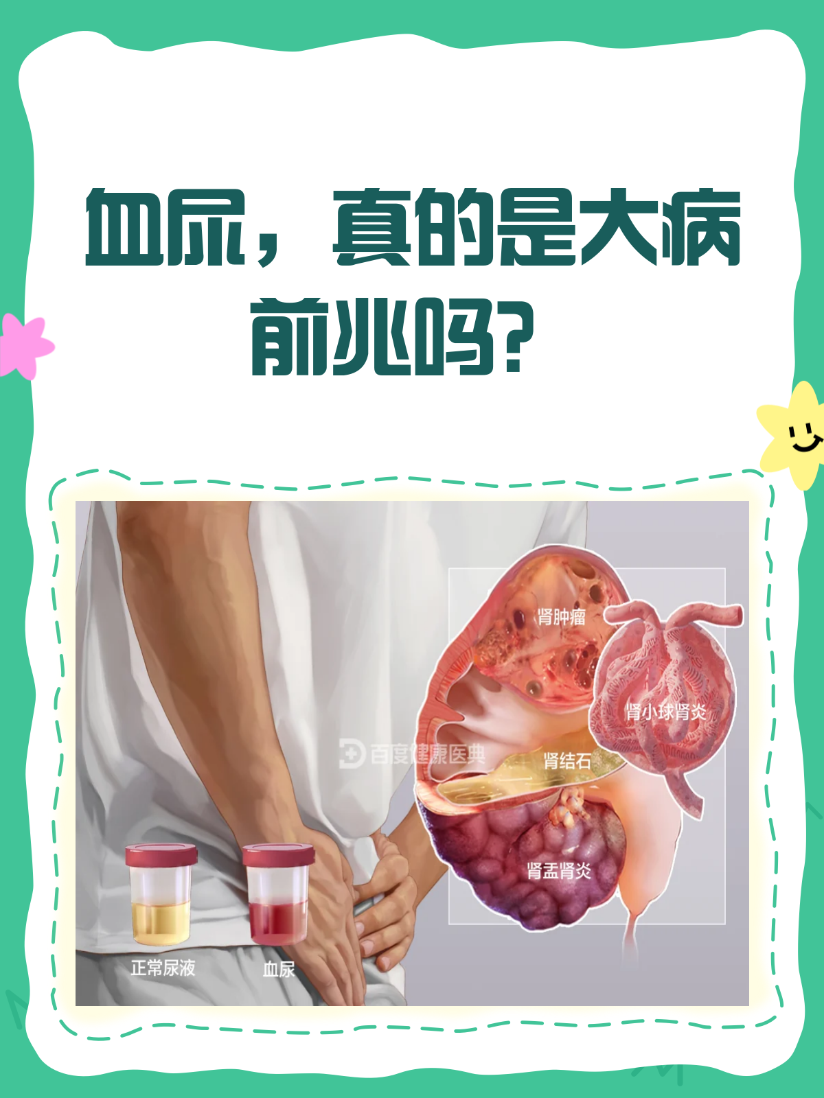 什么是无痛血尿?