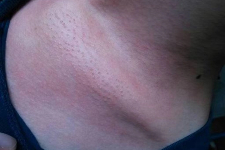 毛状白斑是艾滋病什么阶段才出现?