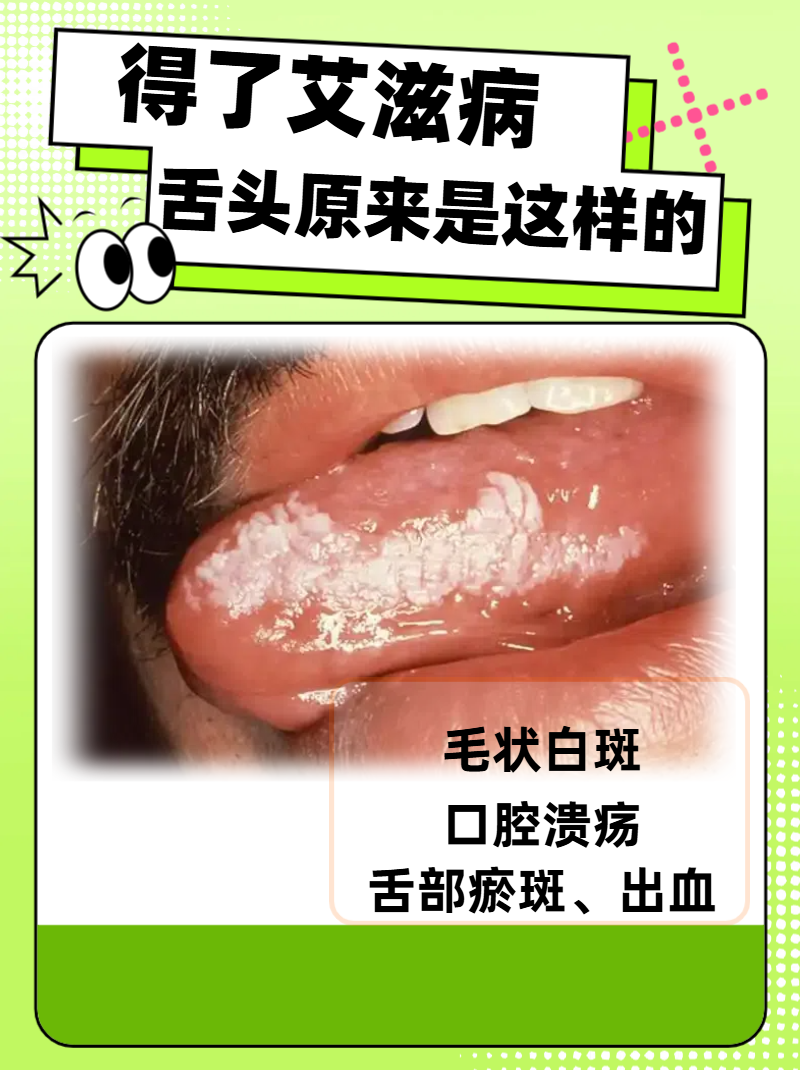 毛状白斑是艾滋病什么阶段才出现?