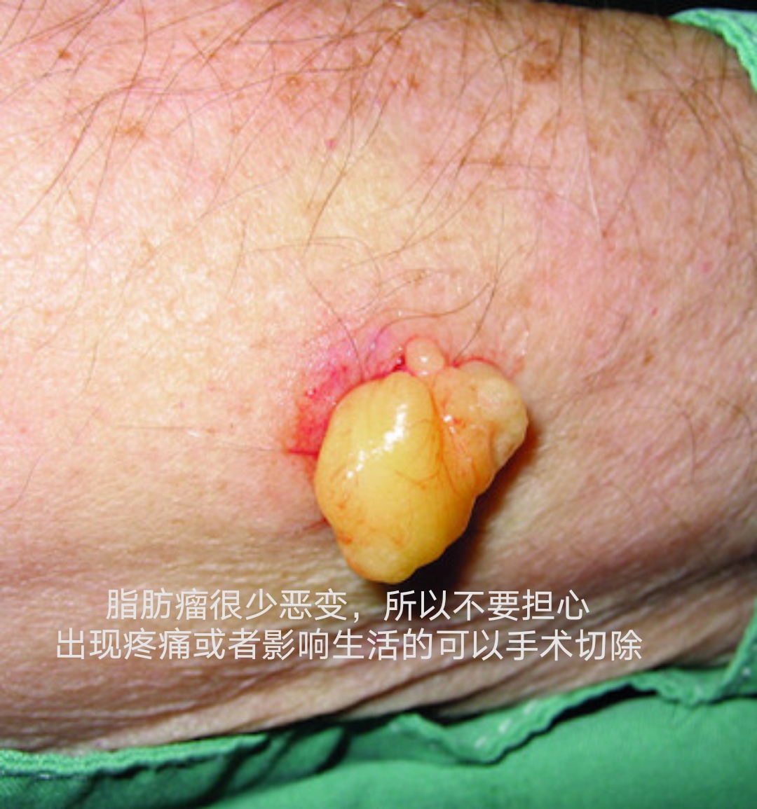 脂肪瘤要紧吗