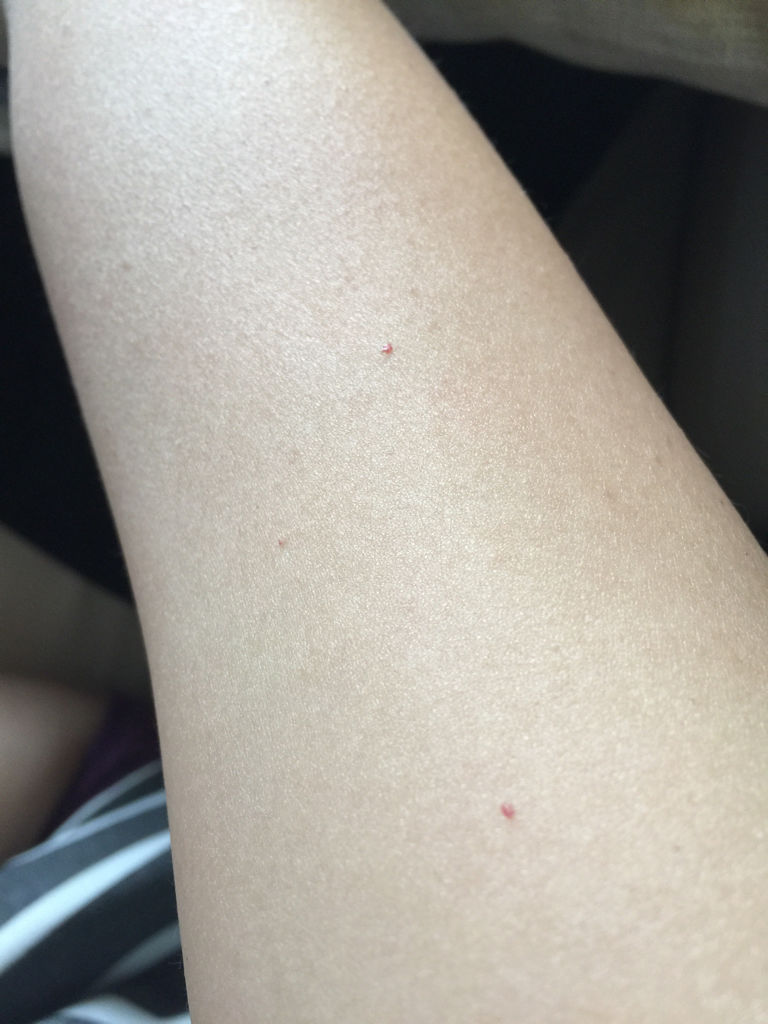 手臂有针尖样的出血点