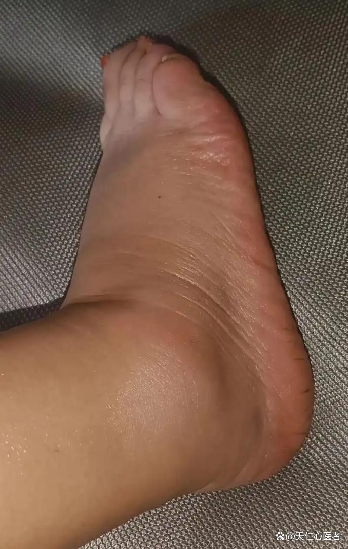 男性尿酸高有什么症状
