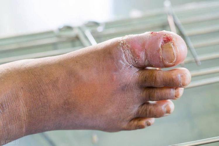 高血糖症状及表现