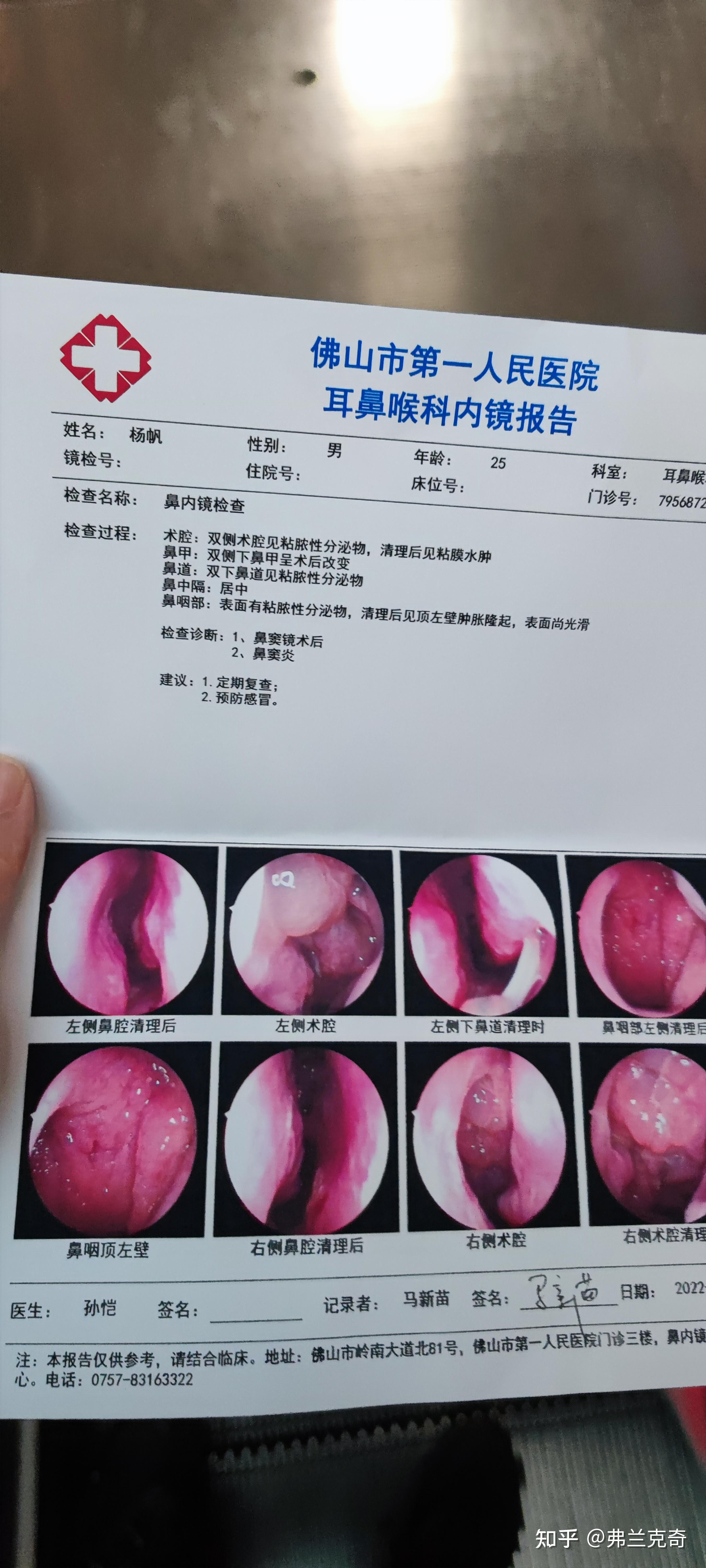 中耳炎手术后多久恢复