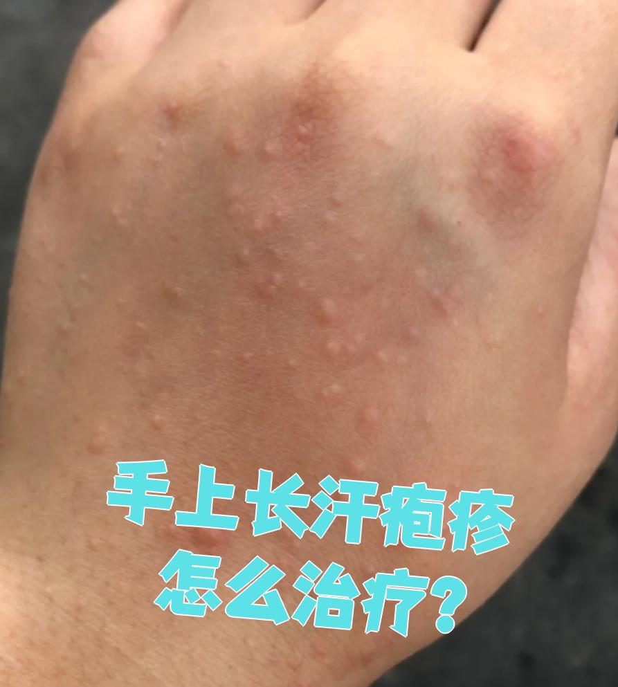手上起汗疱疹怎么治疗