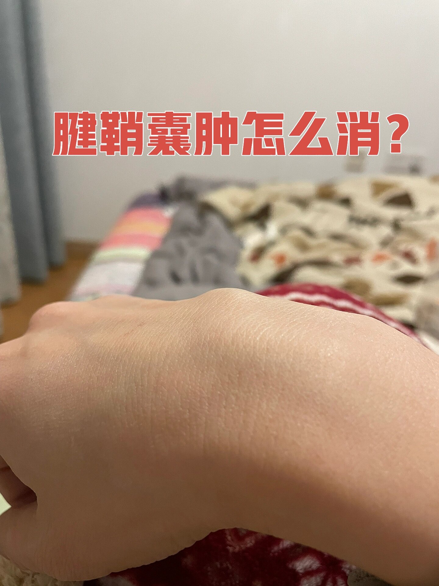 腱鞘囊肿挂什么科