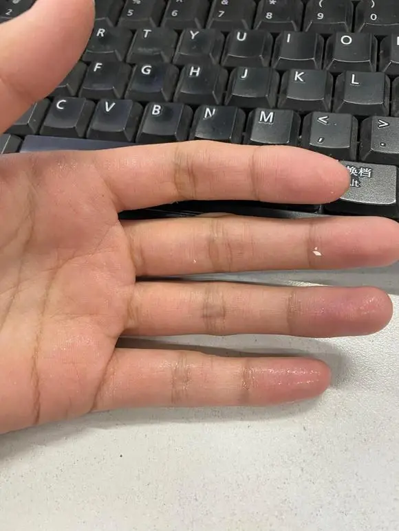 手汗是怎么回事