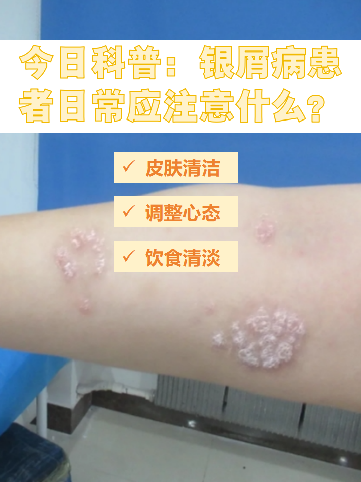 如何治疗牛皮癣