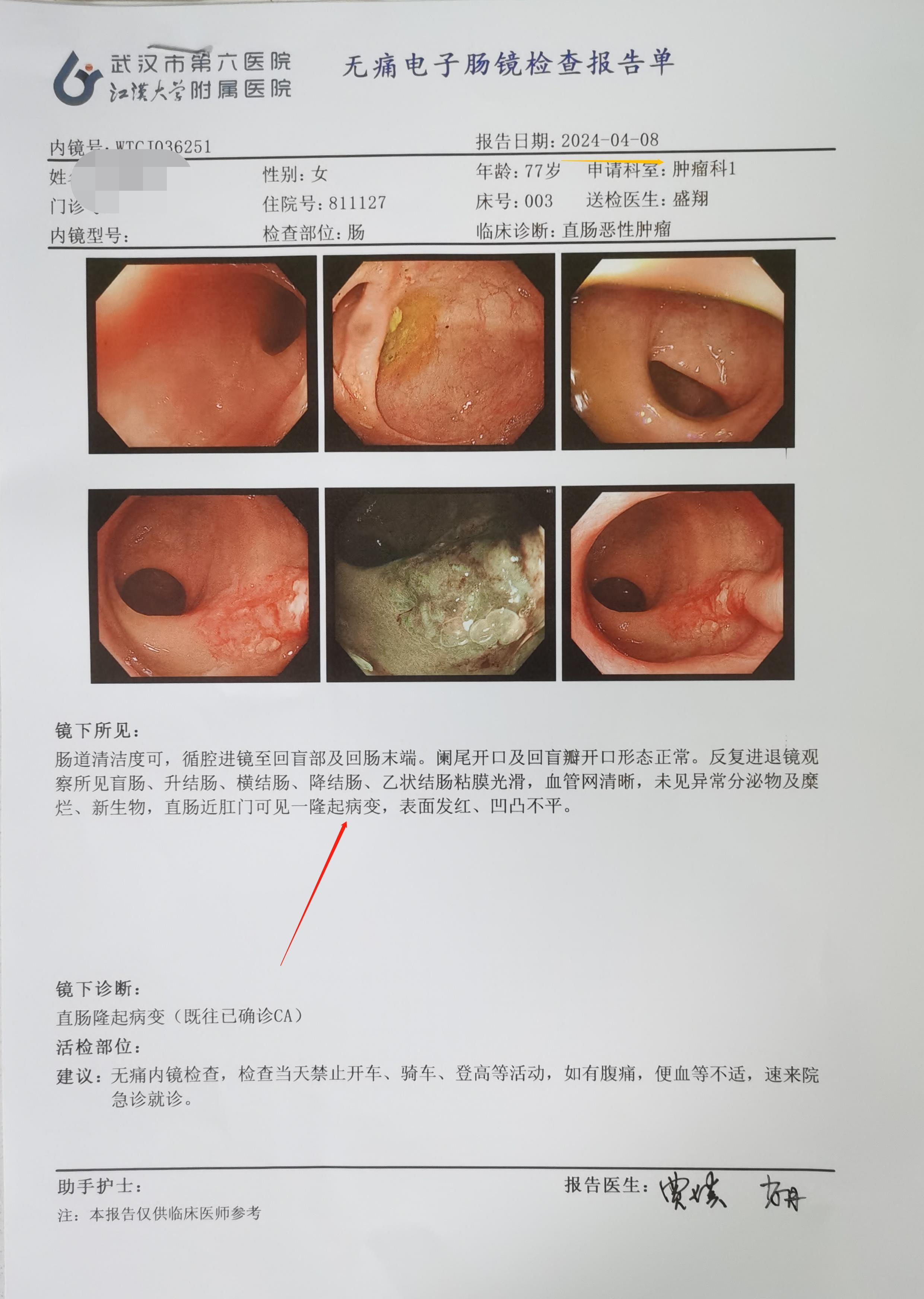 直肠癌症状是什么