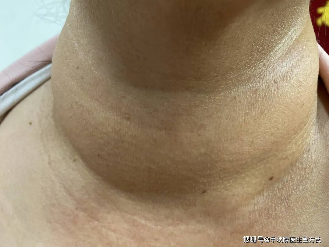 桥本甲状腺炎严重吗?