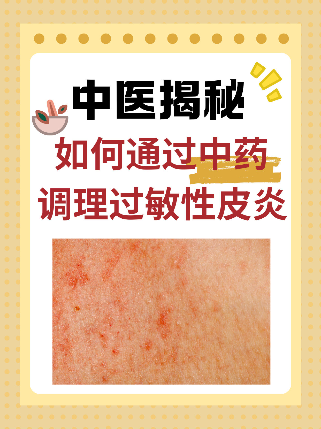 过敏性皮炎要怎么治疗