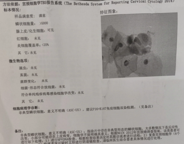非典型鳞状上皮细胞是什么意思